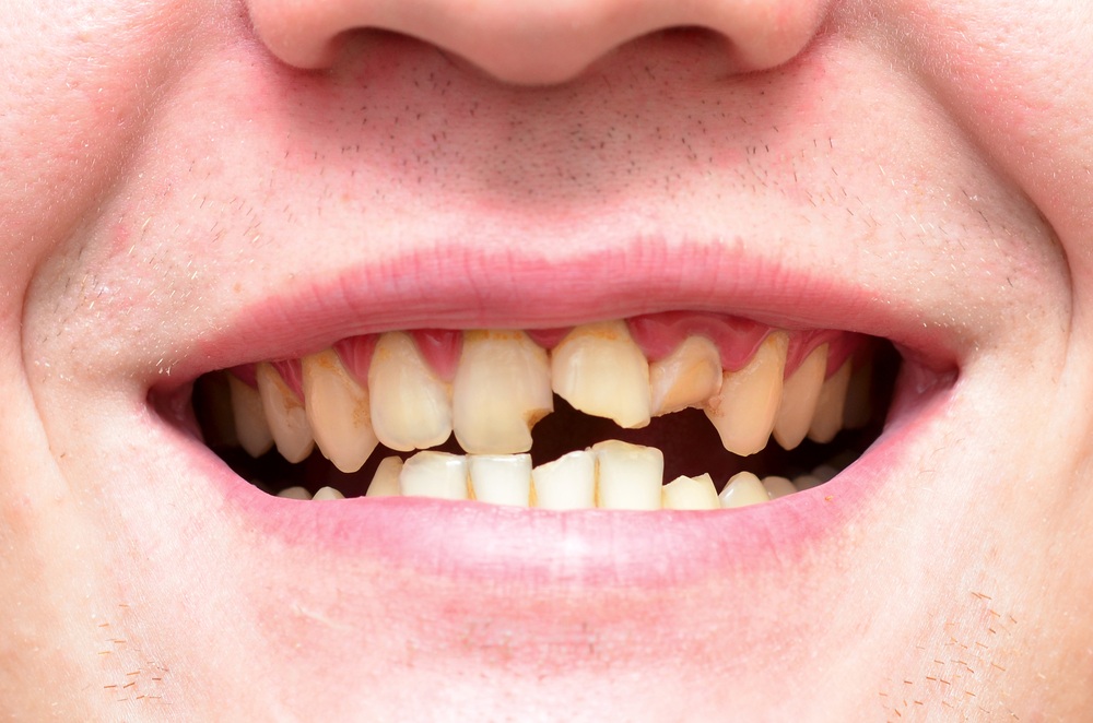 O que significa sonhar com dente quebrado?